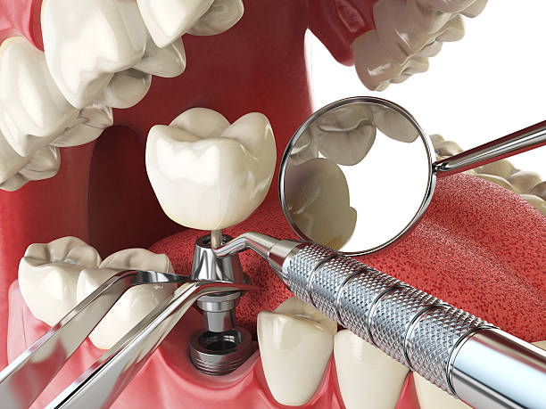 Best Emergency Wisdom Teeth Removal in East Hills, NY